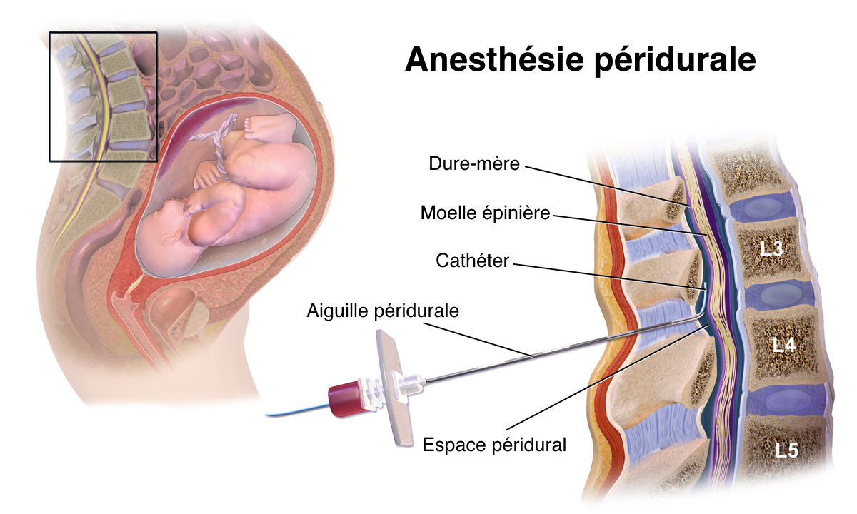 Péridurale – Service d'anesthésie