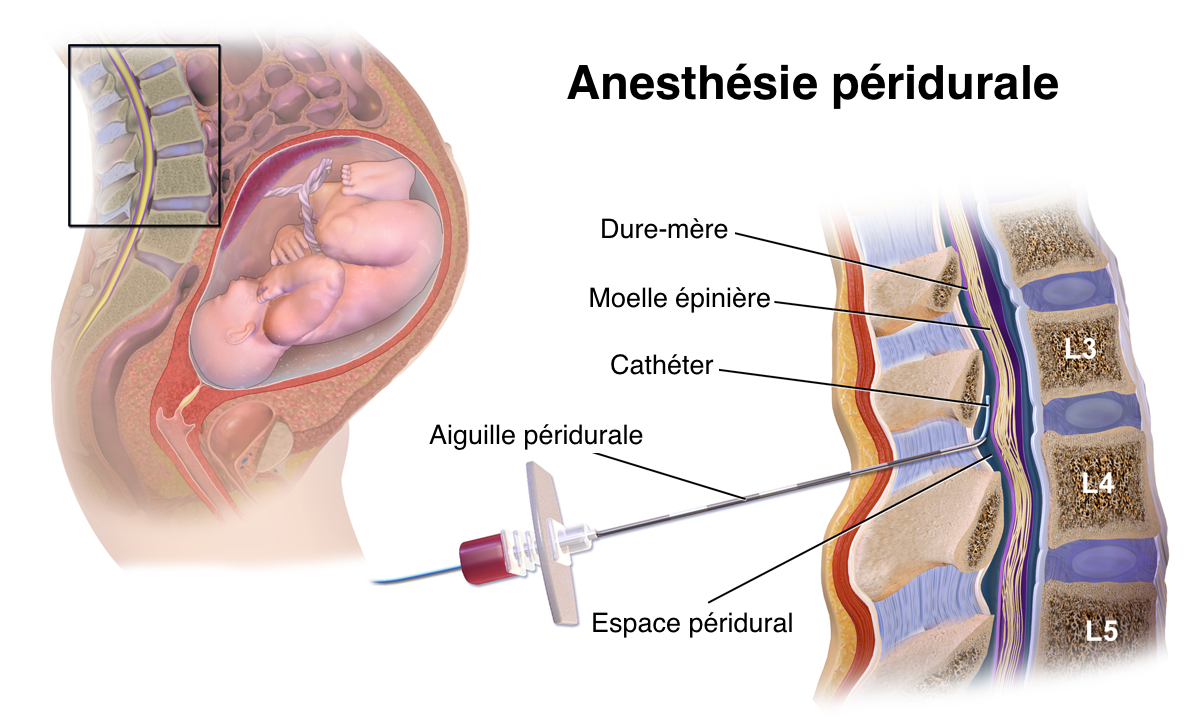 Sonde urinaire : pose et effets secondaires